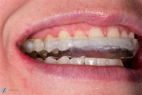 burnsville mn night guard|Burnsville Mouth Guards .